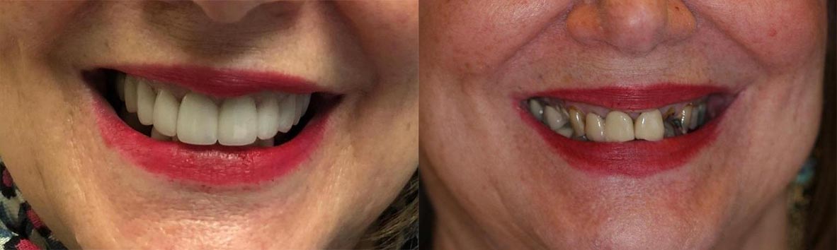 Before and after smile treatment at Gulf Gate Dental