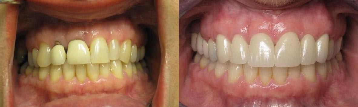 Before and after smile treatment at Gulf Gate Dental