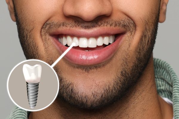 diagram of a dental implant in a young man's mouth