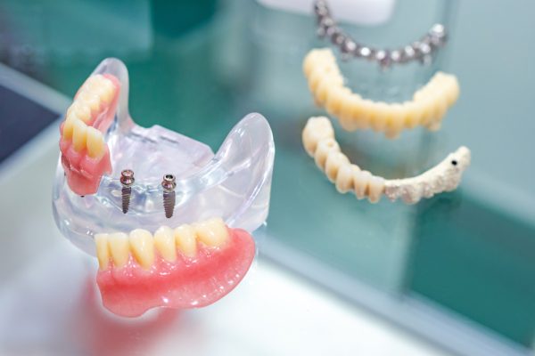 dental implants and removable dentures